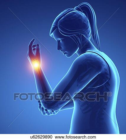 Stock Image - Woman with wrist pain, computer illustration.. Fotosearch
