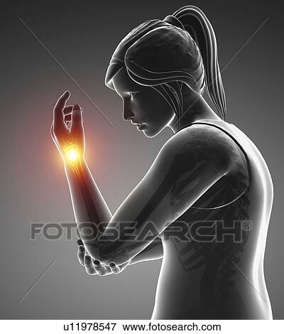 Stock Photo - Woman with wrist pain, computer illustration.. Fotosearch