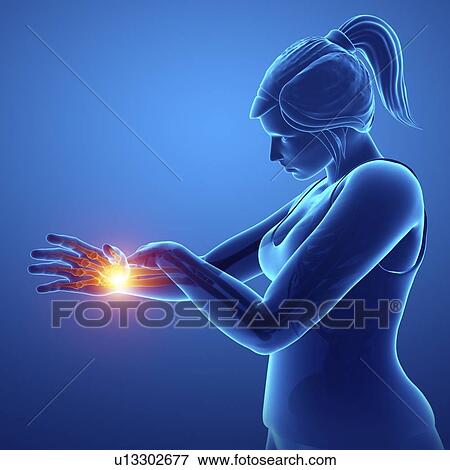 Stock Photo - Woman with wrist pain, computer illustration.. Fotosearch