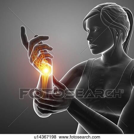 Woman with wrist pain, computer illustration. View Large Photo Image Stock Photo - Woman with wrist pain, computer illustration.. Fotosearch