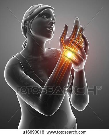 Stock Photo - Woman with wrist pain, computer illustration.. Fotosearch