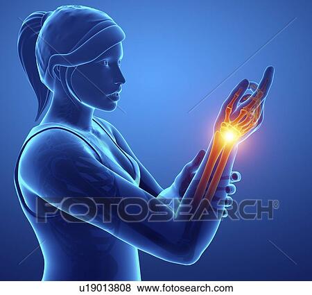 Stock Photo - Woman with wrist pain, computer illustration.. Fotosearch