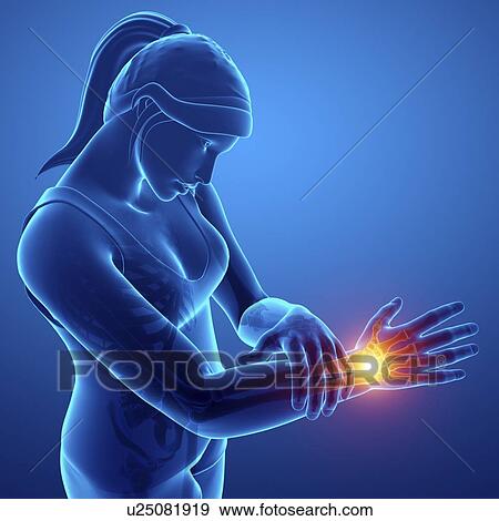 Stock Photo - Woman with wrist pain, computer illustration.. Fotosearch