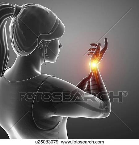 Stock Photo - Woman with wrist pain, computer illustration.. Fotosearch