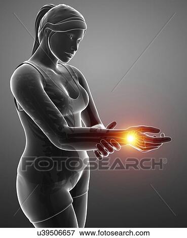Stock Photo - Woman with wrist pain, computer illustration.. Fotosearch