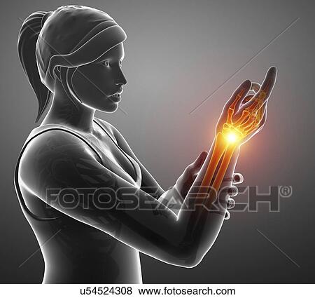 Woman with wrist pain, computer illustration. View Large Photo Image Stock Photo - Woman with wrist pain, computer illustration.. Fotosearch