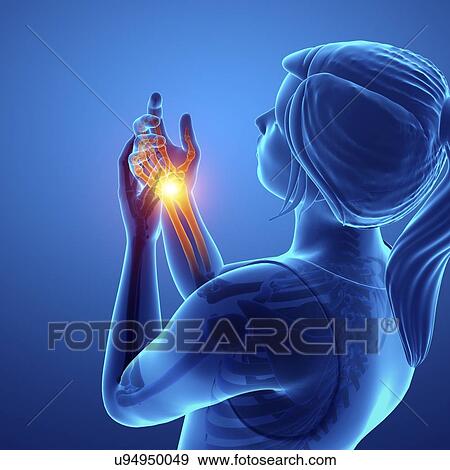 Stock Photo - Woman with wrist pain, computer illustration.. Fotosearch