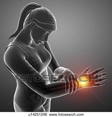 Stock Photograph - Woman with wrist pain, computer illustration.. Fotosearch