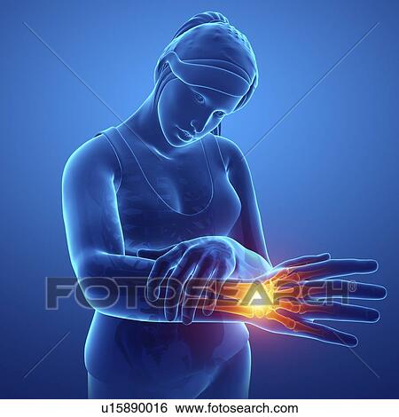 Stock Photograph - Woman with wrist pain, computer illustration.. Fotosearch