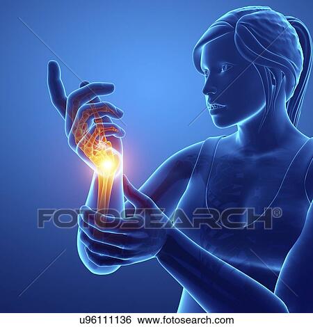 Stock Photograph - Woman with wrist pain, computer illustration.. Fotosearch