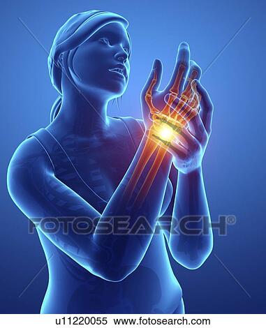 Stock Photography - Woman with wrist pain, computer illustration.. Fotosearch