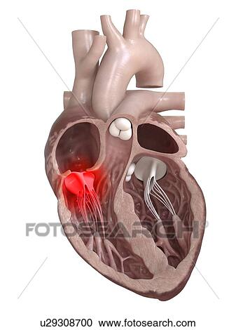 3d rendered illustration of a diseased heart valve. View Large Photo Image Stock Image - 3d rendered illustration of a diseased heart valve.. Fotosearch
