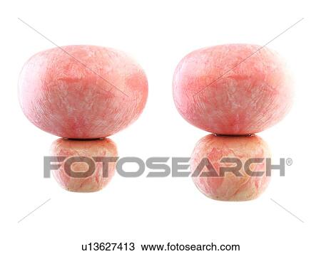Stock Image - 3d rendered illustration of a healthy and an enlarged prostate.. Fotosearch