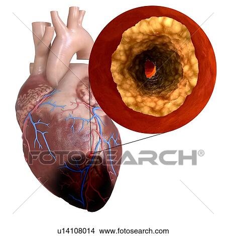 3d rendered illustration of a heart attack. View Large Photo Image Picture - 3d rendered illustration of a heart attack.. Fotosearch