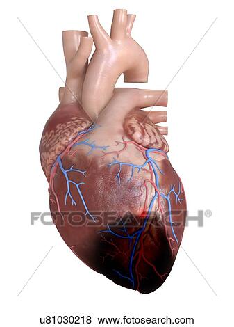 3d rendered illustration of a heart attack. View Large Photo Image Stock Photo - 3d rendered illustration of a heart attack.. Fotosearch
