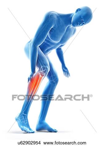3d rendered illustration of a man with a painful calf. View Large Photo Image Picture - 3d rendered illustration of a man with a painful calf.. Fotosearch