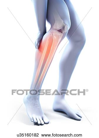 Stock Image - 3d rendered illustration of a man with a painful calf.. Fotosearch