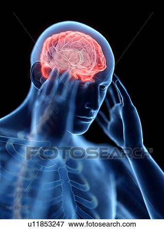 Stock Photo - 3d rendered illustration of a man with a headache.. Fotosearch