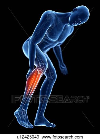 Stock Photo - 3d rendered illustration of a man with a painful calf.. Fotosearch