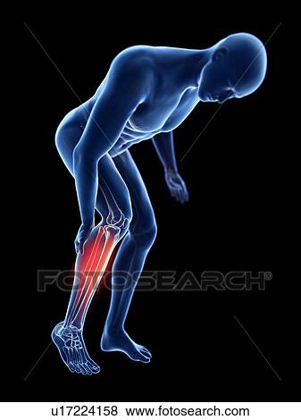 Stock Photo - 3d rendered illustration of a man with a painful calf.. Fotosearch
