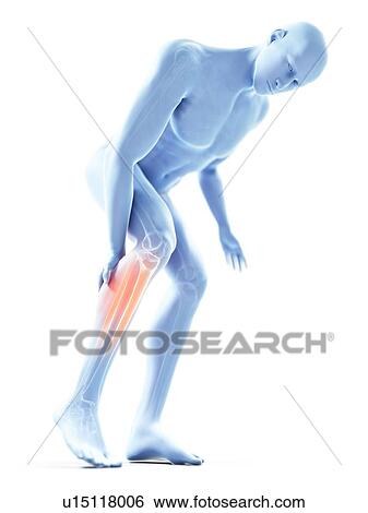 3d rendered illustration of a man with a painful calf. View Large Photo Image Stock Photograph - 3d rendered illustration of a man with a painful calf.. Fotosearch