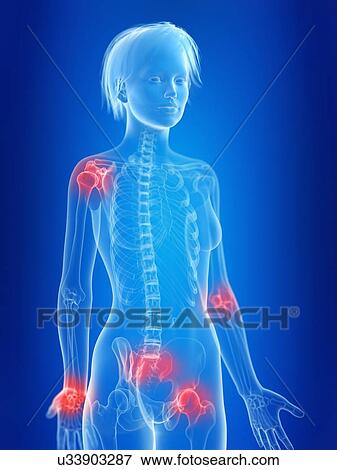 Stock Photo - 3d rendered illustration of a woman's painful joints.. Fotosearch