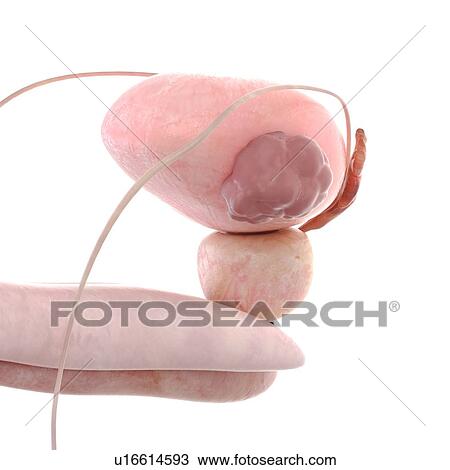 3d rendered illustration of bladder cancer. View Large Photo Image Stock Image - 3d rendered illustration of bladder cancer.. Fotosearch