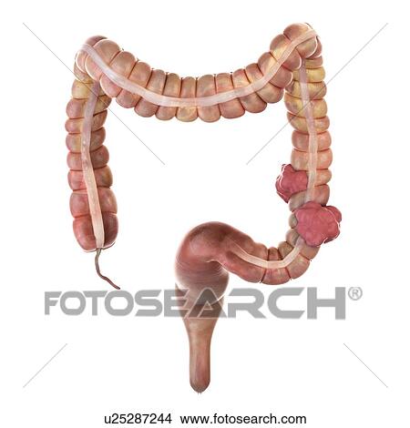 Picture - 3d rendered illustration of colon cancer.. Fotosearch