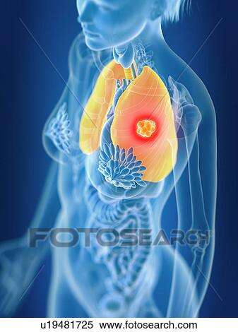 Stock Photography - 3d rendered illustration of female lung cancer.. Fotosearch