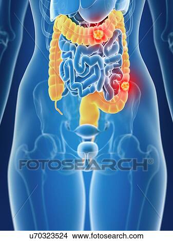 Picture - 3d rendered illustration of female colon cancer.. Fotosearch