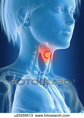 Stock Image - 3d rendered illustration of female larynx cancer.. Fotosearch