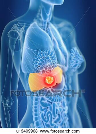 3d rendered illustration of female liver cancer. View Large Photo Image Stock Photo - 3d rendered illustration of female liver cancer.. Fotosearch