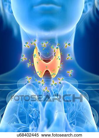 3d rendered illustration of female thyroid gland being attacked by antibodies. View Large Photo Image Stock Photography - 3d rendered illustration of female thyroid gland being attacked by antibodies.. Fotosearch