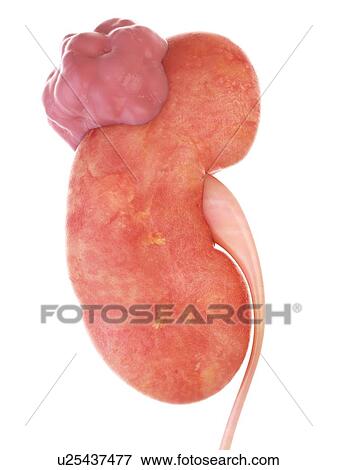 Stock Photo - 3d rendered illustration of kidney cancer.. Fotosearch