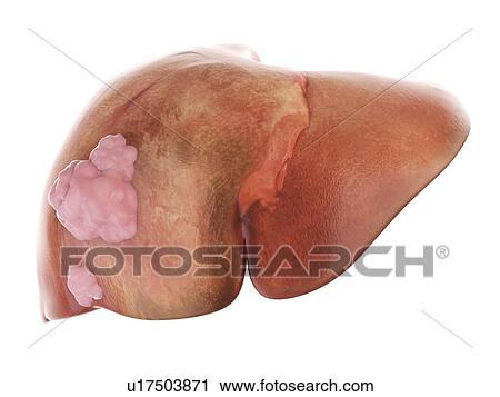 Stock Image - 3d rendered illustration of liver cancer.. Fotosearch
