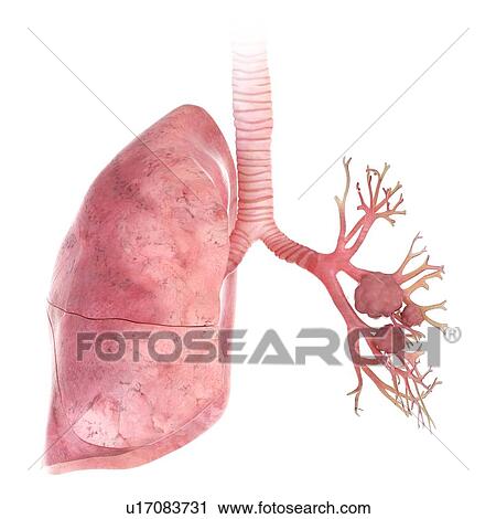 Stock Image - 3d rendered illustration of lung cancer.. Fotosearch