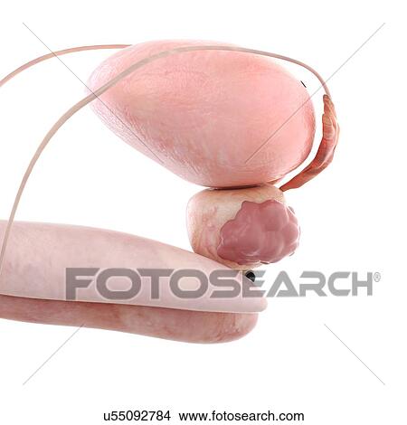 Picture - 3d rendered illustration of prostate cancer.. Fotosearch