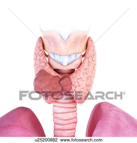 Stock Image - 3d rendered illustration of thyroid gland cancer.. Fotosearch