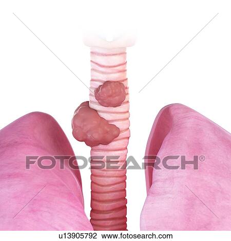 3d rendered illustration of trachea cancer. View Large Photo Image Stock Image - 3d rendered illustration of trachea cancer.. Fotosearch