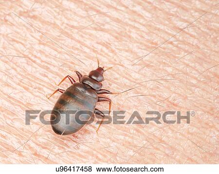 Stock Photo - Illustration of a bedbug on human skin.. Fotosearch