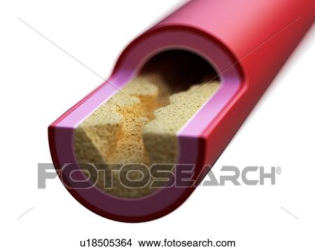 Picture - Illustration of a blocked artery.. Fotosearch