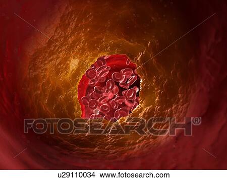 Picture - Illustration of a blocked artery.. Fotosearch
