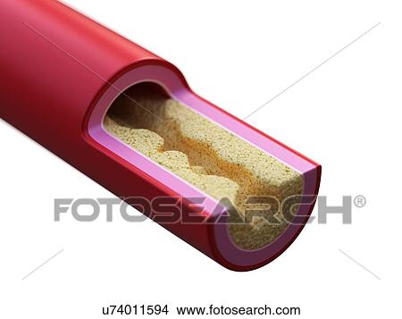 Illustration of a blocked artery. View Large Photo Image Picture - Illustration of a blocked artery.. Fotosearch