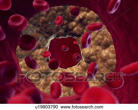 Illustration of a blocked artery. View Large Photo Image Stock Image - Illustration of a blocked artery.. Fotosearch