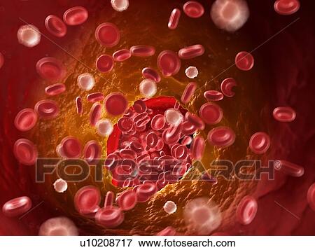 Stock Photo - Illustration of a blocked artery.. Fotosearch
