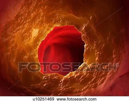 Illustration of a blocked artery. View Large Photo Image Stock Photo - Illustration of a blocked artery.. Fotosearch