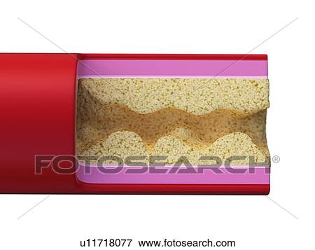 Stock Photo - Illustration of a blocked artery.. Fotosearch