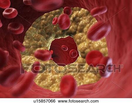 Stock Photograph - Illustration of a blocked artery.. Fotosearch