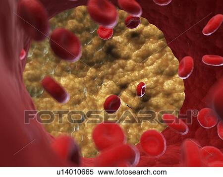 Illustration of a blocked artery. View Large Photo Image Stock Photography - Illustration of a blocked artery.. Fotosearch
