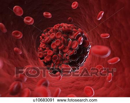 Stock Image - Illustration of a blood clot.. Fotosearch